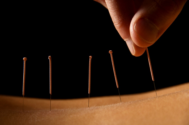 Learn the Acupuncture Basics