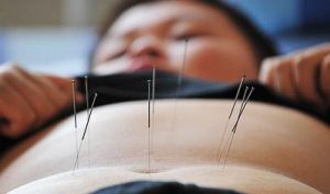 acupuncture_for_weight_loss