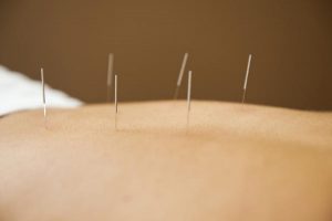 acupuncture_helps_weight_loss