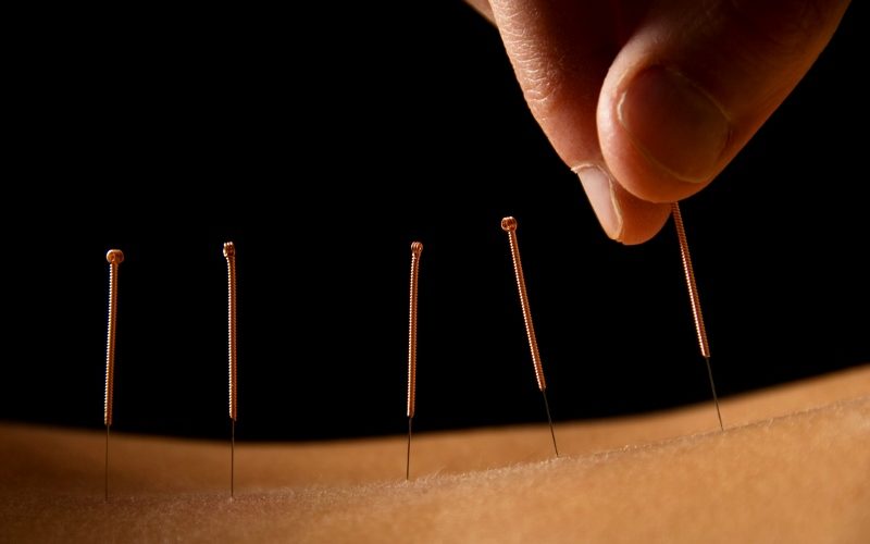 Acupuncture basics